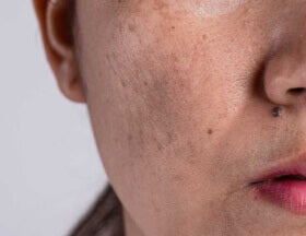 Dull skin is caused by dehydration, dead skin cell buildup, and environmental factors. These factors block cellular turnover that is needed to promote healthy, radiant skin.