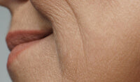 Loss of skin elasticity is caused by aging and lifestyle factors such as smoking, lack of sleep, and drastic weight loss. These factors break down collagen and elastin fibers in the skin, causing it to lose its firmness and elasticity.