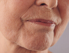 Wrinkles and wrinkle depth are primarily caused by sun exposure, lack of moisture, and aging. These factors break down collagen and elastin fibers in the skin, causing it to lose its firmness and elasticity.